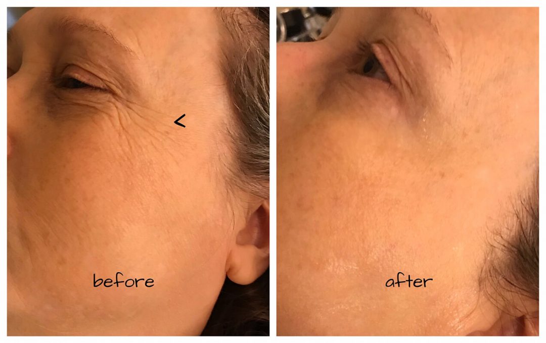 Radio Frequency For Skin Tightening - Fix That Droopy Denver Skin